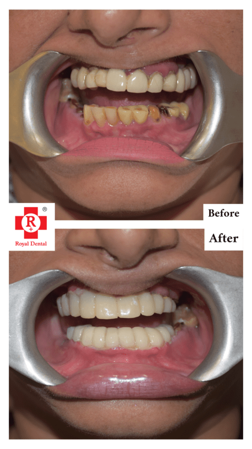 Smile Makeover