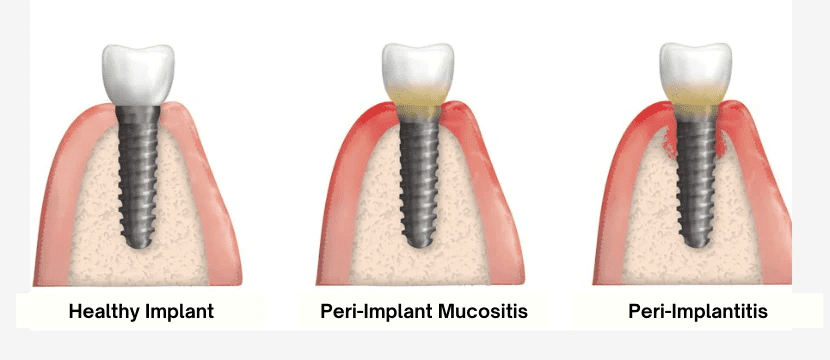 peri-implantitis implant infection