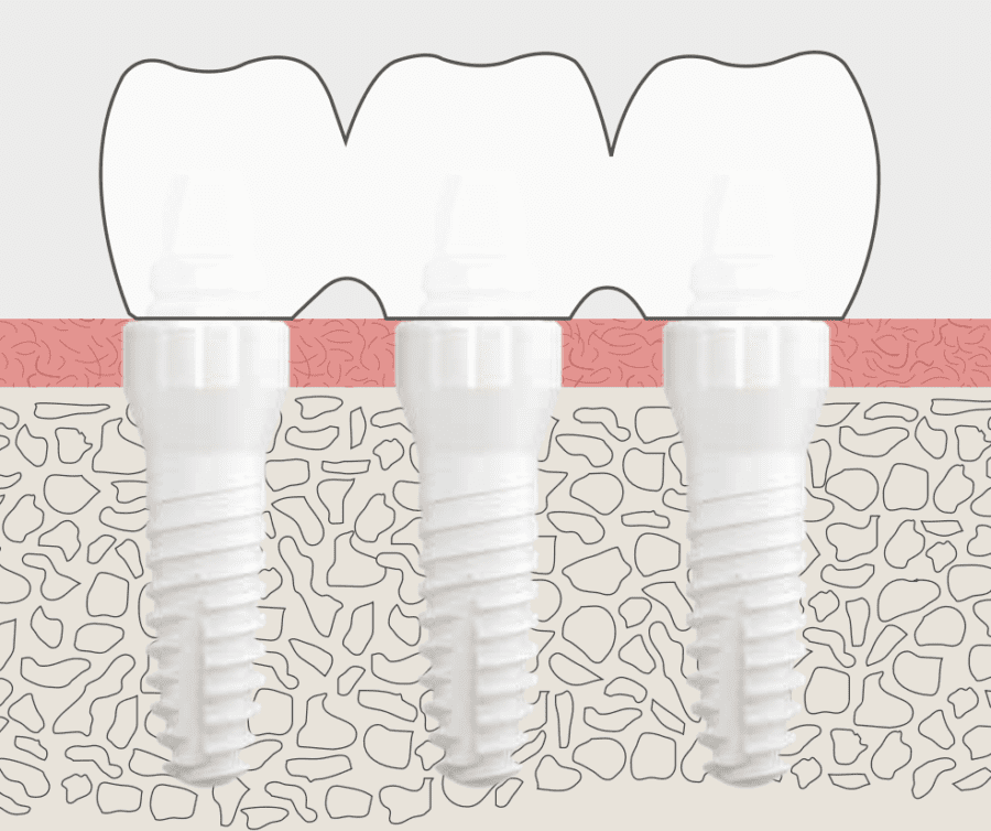 zirconia implant with dental crown