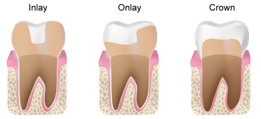 inlay and onlay dental filling