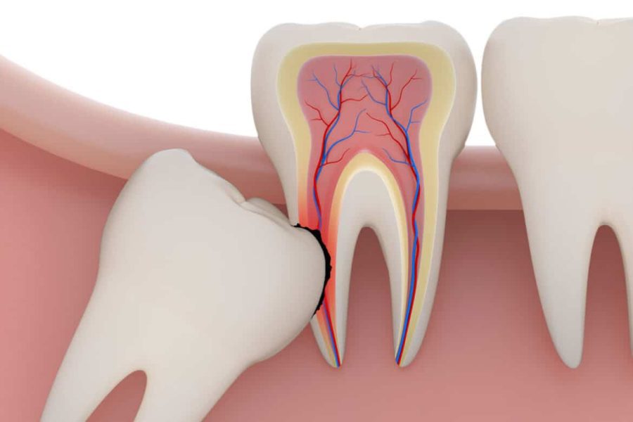 Wisdom tooth Extraction