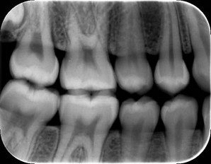 Bitewing X-rays near me | Royal dental care clinic in Mumbai
