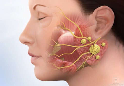 Dental Implants and Salivary Glands