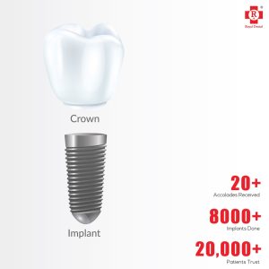 dental crown implant treatment