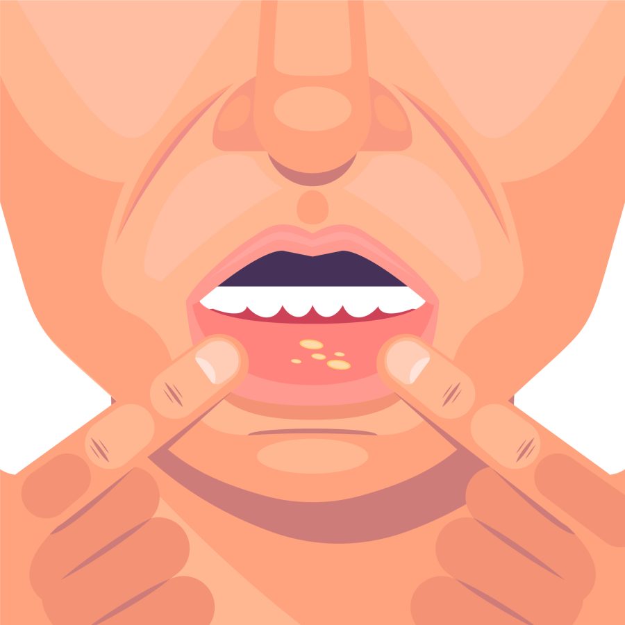 skin peeling inside mouth
