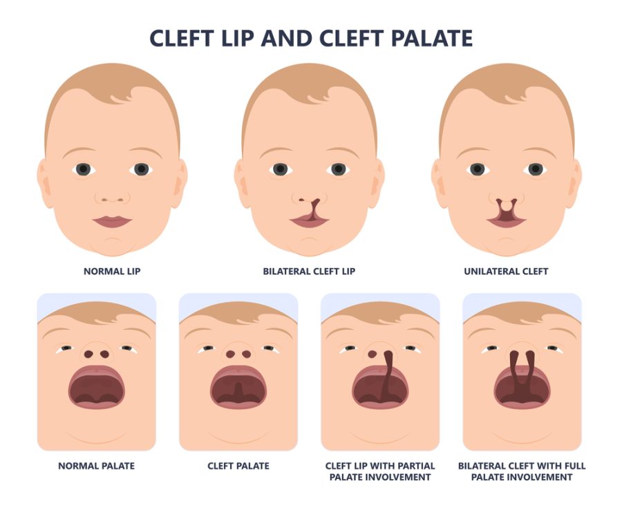 Cleft Lip Surgery Cost in India
