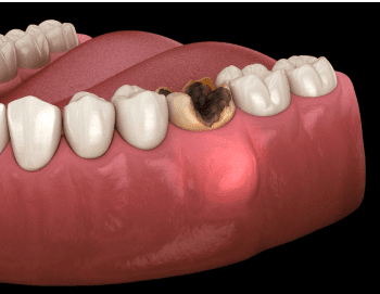 Cyst on gums | Worst case of tooth decay