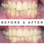 One Day Dentistry - Full Mouth