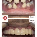 Before and after dental correction.