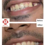 Single missing tooth | Single Stage Implant