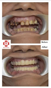 Dental transformation before and after