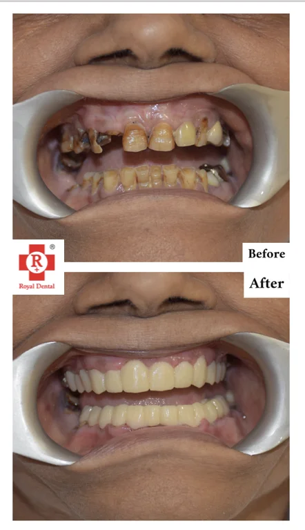 Dental transformation before and after