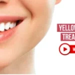 Yellow teeth stains