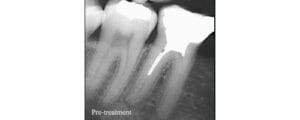 before after xray