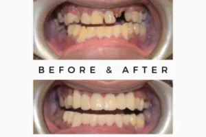 root canal procedures in Kandivali East