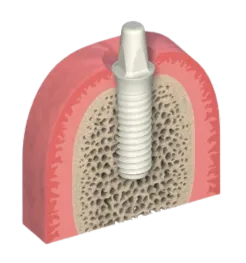 Tooth Implant