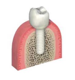 Zirconia Dental Implant