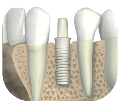 Zirconia Dental Implants