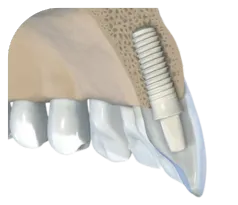 Zirconia Implant