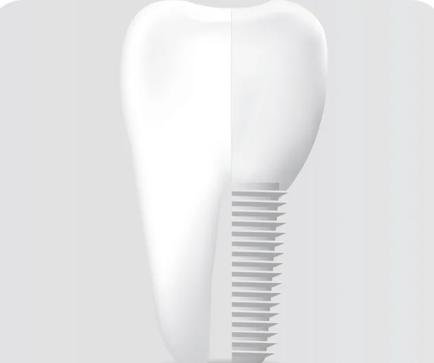 Same Day Fixed Teeth with Dental Implant