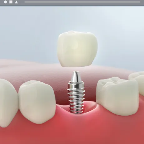 Dental Implant Single Stage Loading