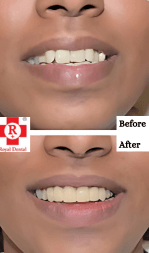 Before After