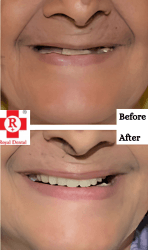 Before After