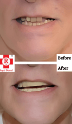Before After