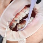orthodontic braces aligners