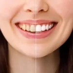 Teeth Whitening