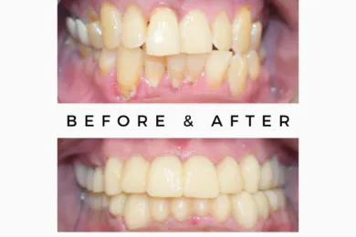 Cosmetic Dentistry Makeover