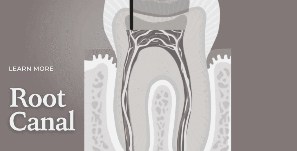 Root Canal Treatment