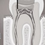 Root Canal Treatment
