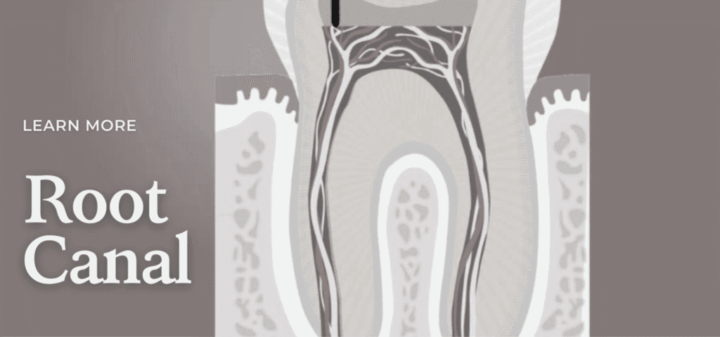 Root Canal Treatment