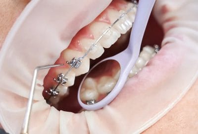 Braces and Wires | File | Orthodontist