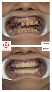 Moving teeth