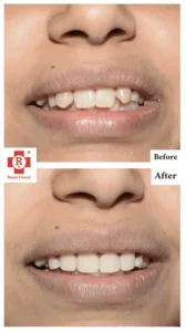 Teeth Straightening in Mumbai