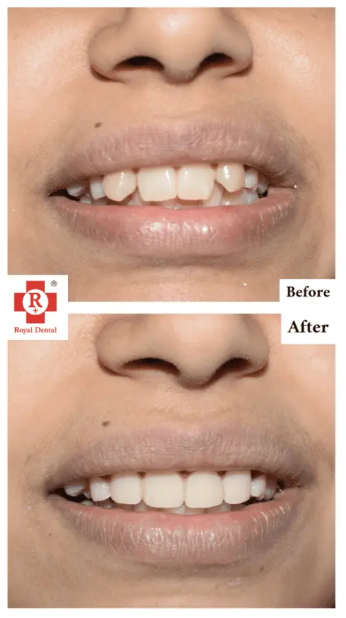 Teeth Straightening in Mumbai