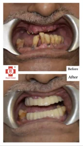Tooth Mobility