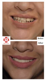 Crooked to Fixed Teeth
