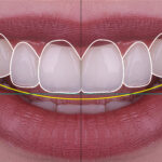 Gummy Smile Treatment