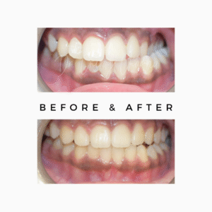 Teeth Straightening & Beautification