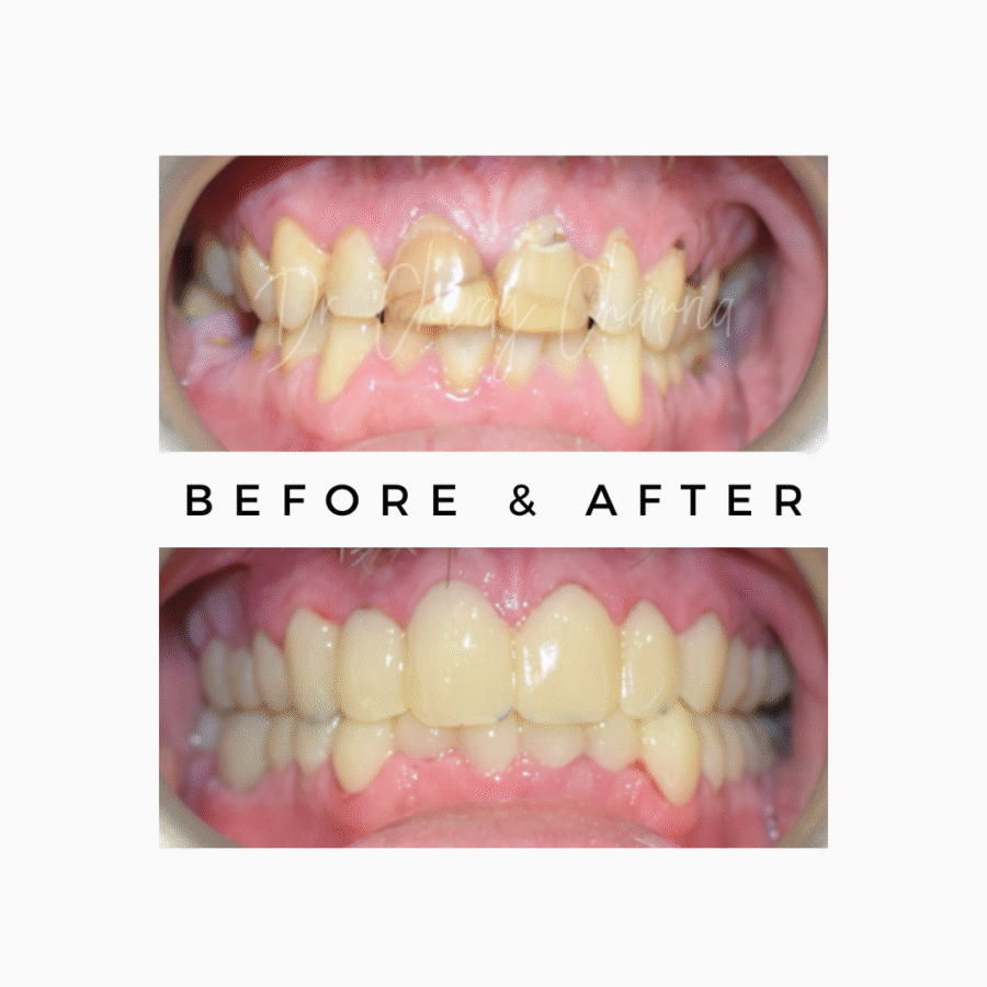 Smile Makeover - Saving Teeth with Root Canal