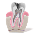Root Canal Treatment with Crown