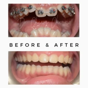 Braces and Wires Treatment Result