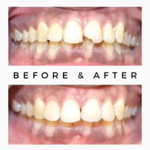 Chipped Tooth Replacement