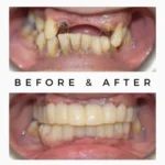 Cosmetic Dentistry Befor After Result