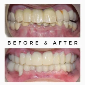 Full Mouth Makeover Results in Mumbai