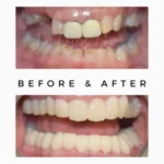 Full Mouth Smile Result in Kandivali