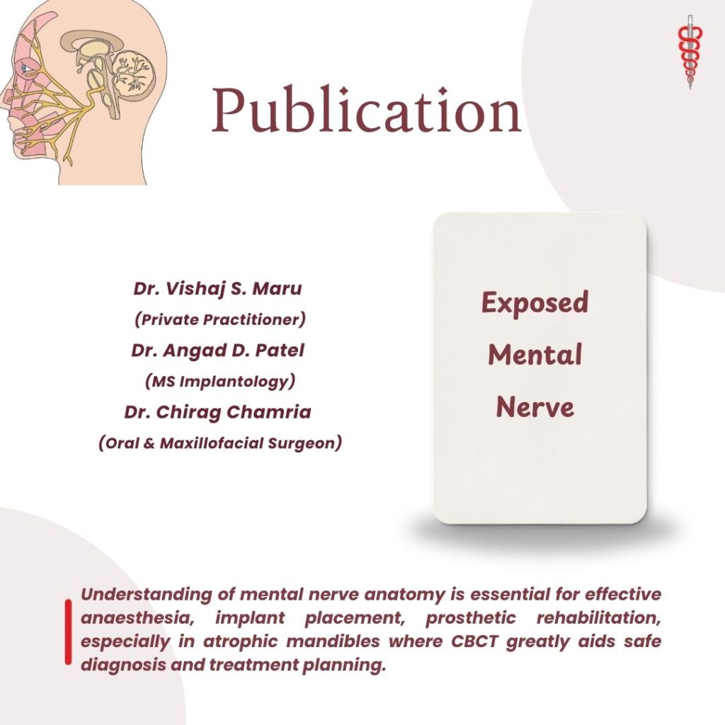 Exposed Mental Nerve Publication